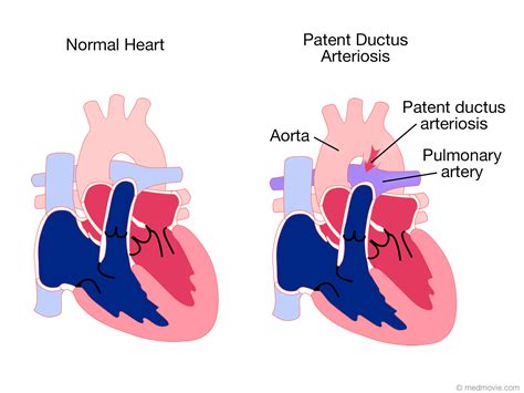 atabs dukit|Patent Ductus Arteriosus .